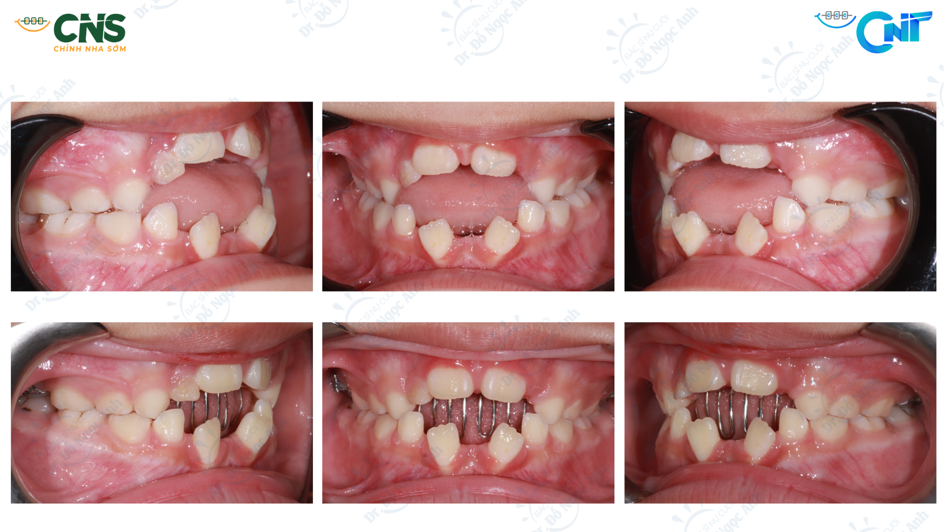 Nuôi con bằng sữa mẹ, ti giả và các thói quen mút: bằng chứng về vai trò phòng ngừa sai khớp cắn ở bộ răng sữa