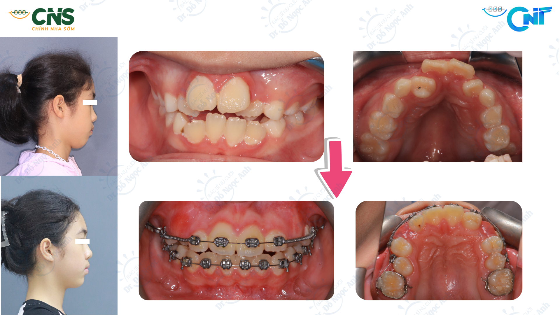 Thở miệng và rối loạn hô hấp khi ngủ ở trẻ em: ảnh hưởng lên tăng trưởng sọ mặt và vai trò của phát hiện sớm trong chỉnh nha phòng ngừa
