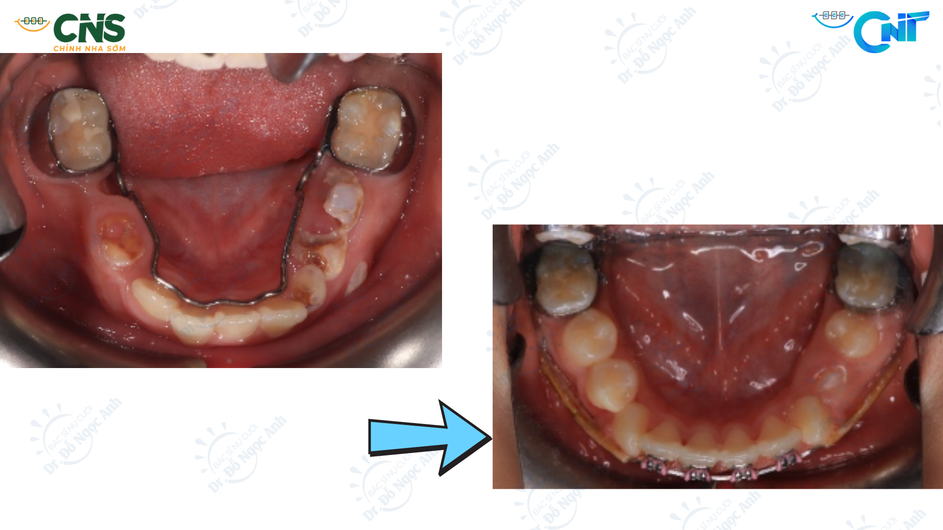 Mất sớm răng sữa và bộ giữ khoảng: bằng chứng về mất khoảng, chỉ định và giới hạn của khí cụ