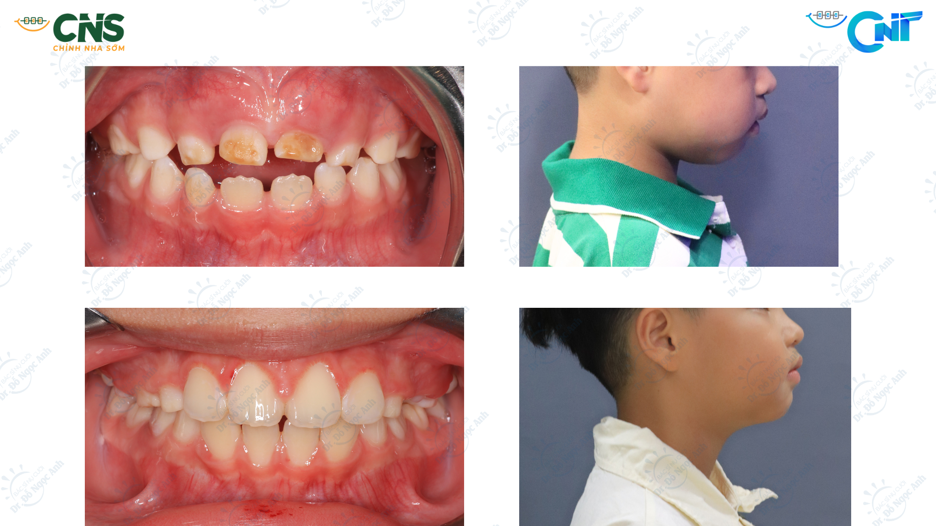 Mút ngón tay kéo dài ở trẻ em: hậu quả trên răng - xương và hiệu quả của các biện pháp can thiệp bỏ thói quen