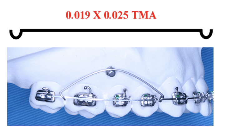 Điều trị canting mặt phẳng nhai bằng cung lún một phần hàm với neo chặn minivis