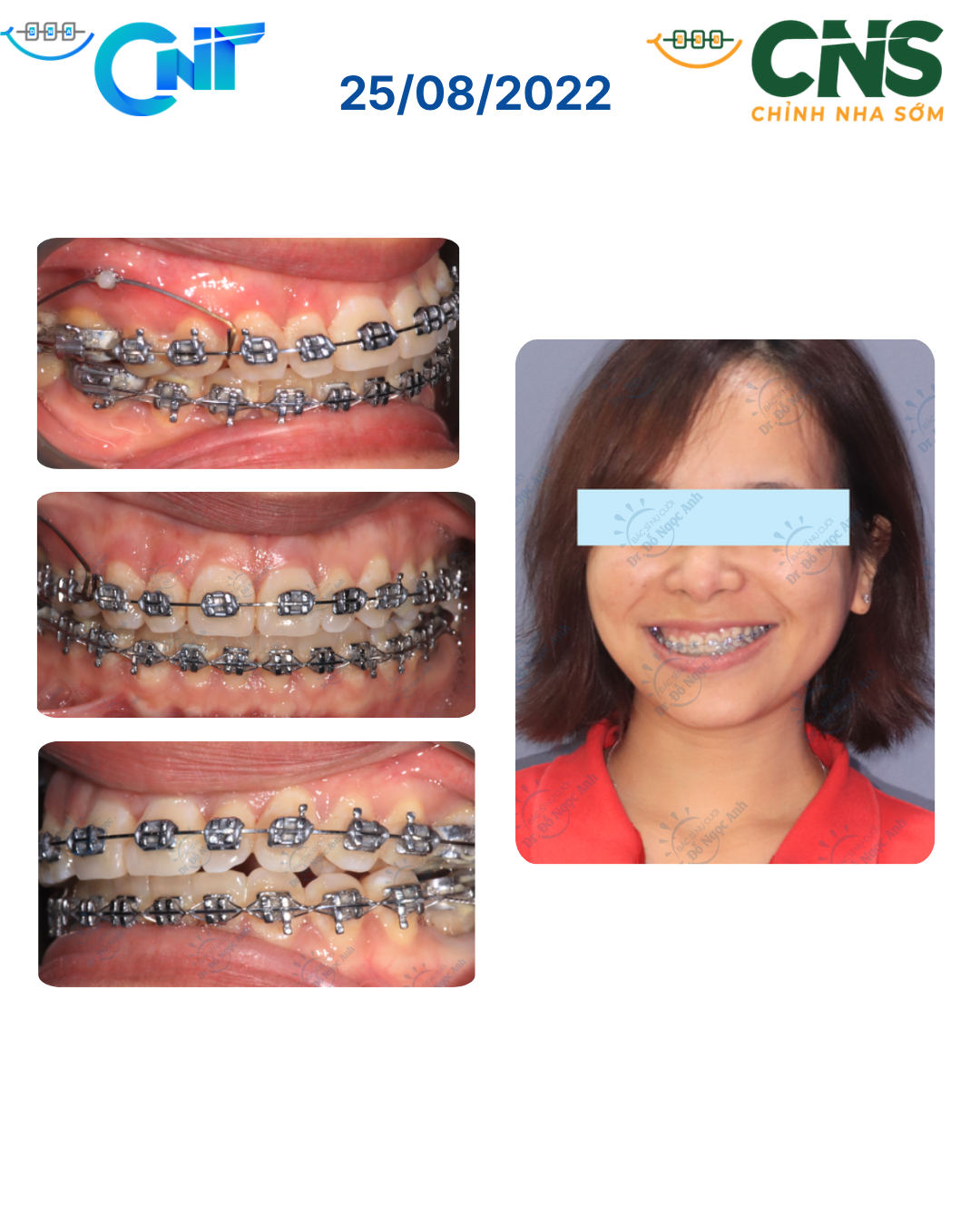 Điều trị canting mặt phẳng nhai gây cười nghiêng bằng lún một bên hàm trên với neo chặn minivis