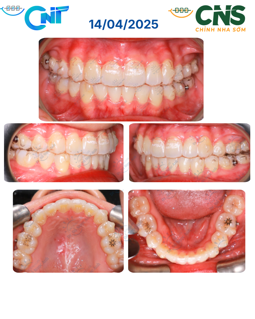 Niềng khay trong suốt nhổ bốn răng cối nhỏ thứ nhất: thiết kế ClinCheck để làm đều, đóng khoảng và kiểm soát chiều đứng