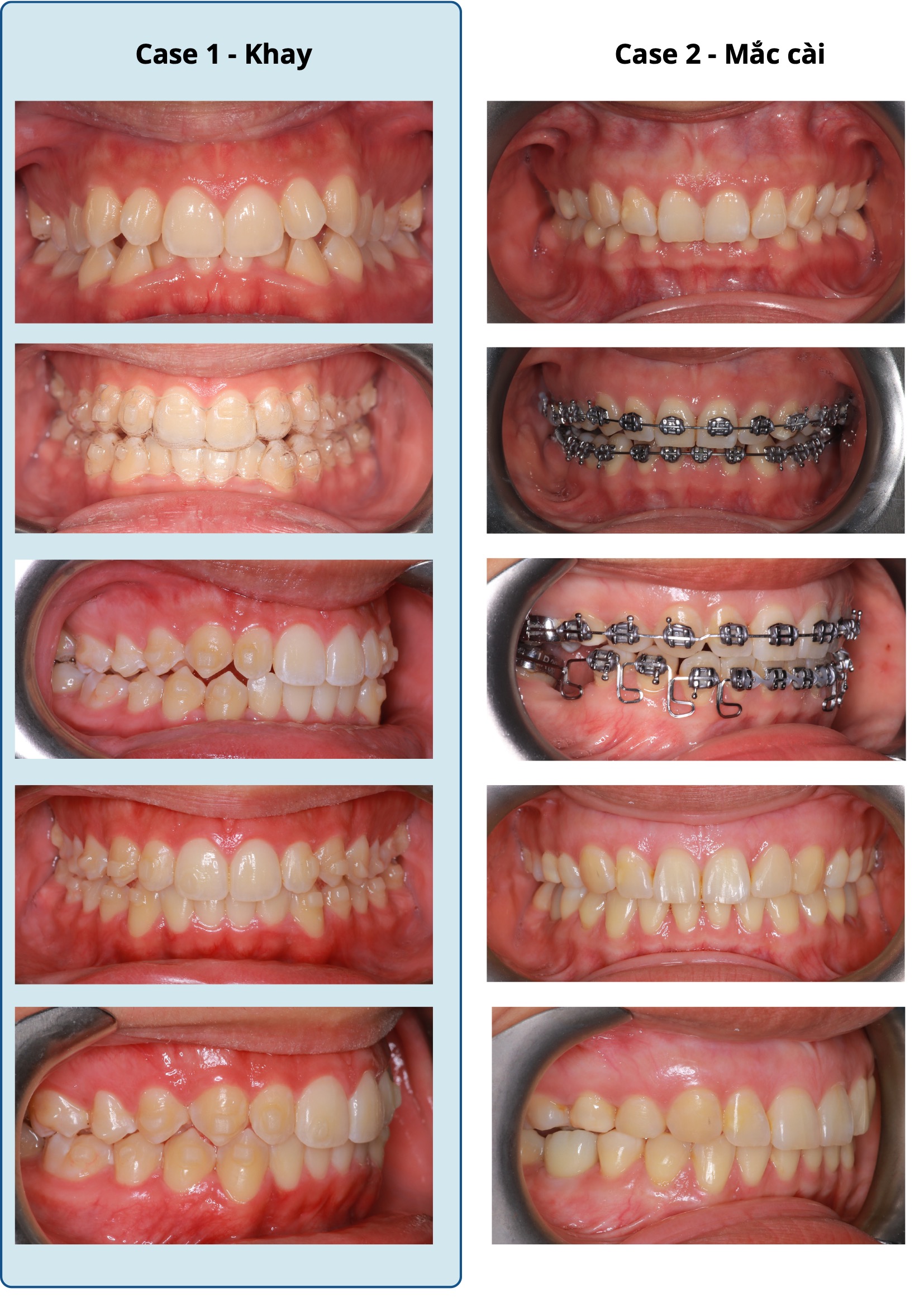 SO SÁNH ĐIỀU TRỊ SAI KHỚP CẮN HẠNG II: NIỀNG KHAY TRONG SUỐT vs MẮC CÀI DÂY THẲNG – MEAW