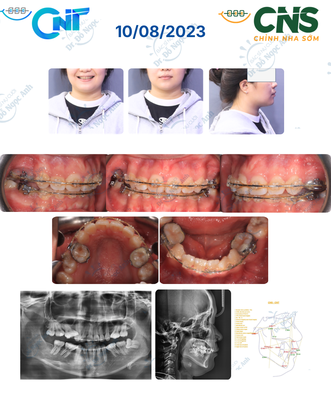 Hậu quả của nhổ 8 răng cối nhỏ: điều trị lại bằng dây thẳng dựng trục răng cối lớn và MEAW