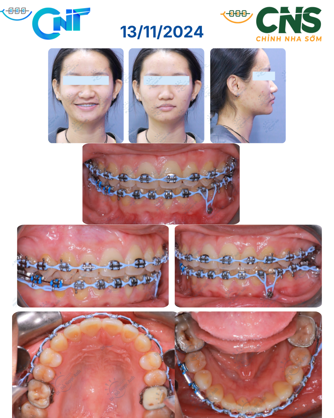 Ca giáp biên không nhổ răng cối nhỏ trên bệnh nhân mặt ngắn: nong hàm, dựng trục răng sau và kéo lui hai hàm bằng vis