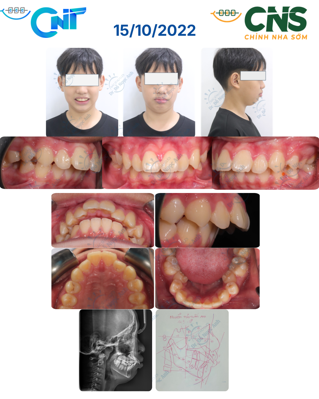 Ca hô xương, cắn chìa lớn, dạng mặt Mesio điều trị với nhổ răng cối nhỏ và kéo lui hàm trên bằng vis IZC