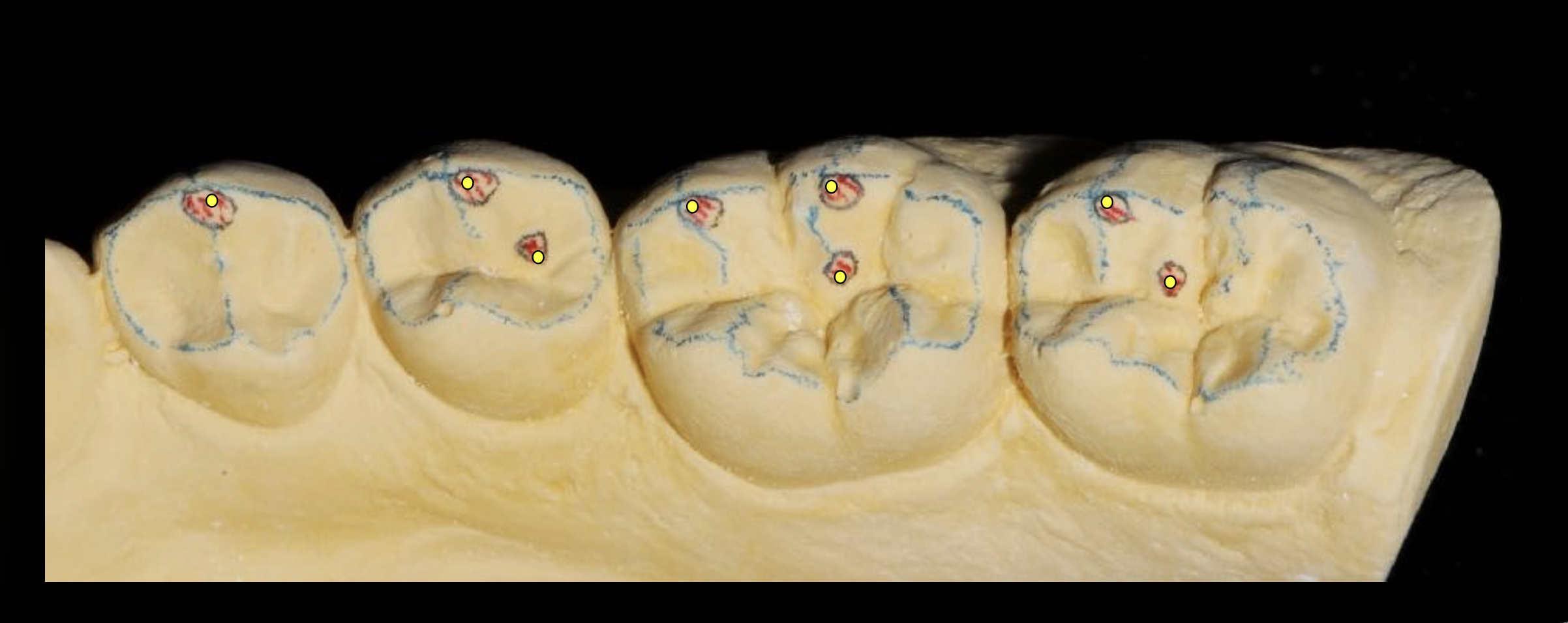 Điểm chạm khớp: quy tắc MUDL/DUML, centric stops và “C”-ridge / “C”-groove