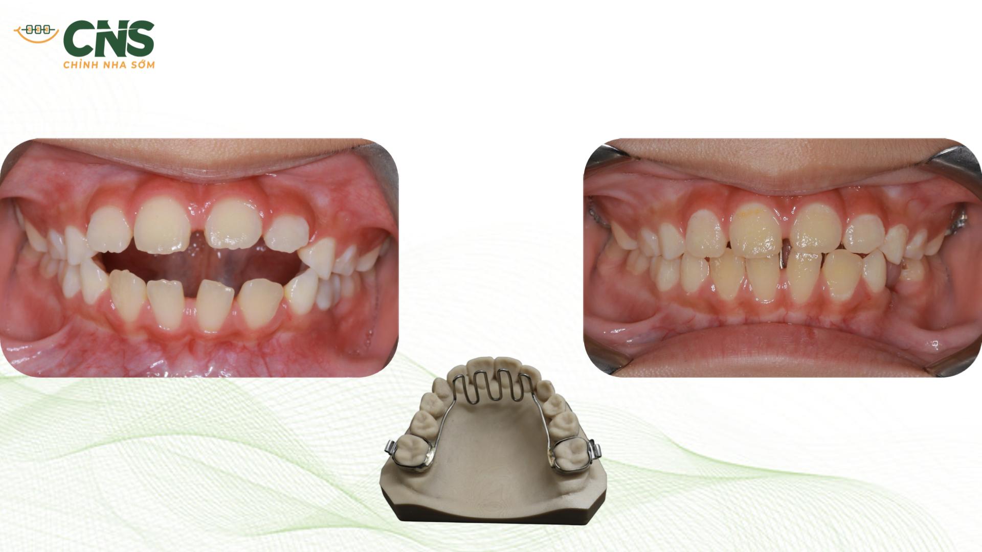 Can Thiệp Chỉnh Nha Sớm: Chỉ Định, Thời Điểm & Cơ Sở Bằng Chứng (Phần 1)