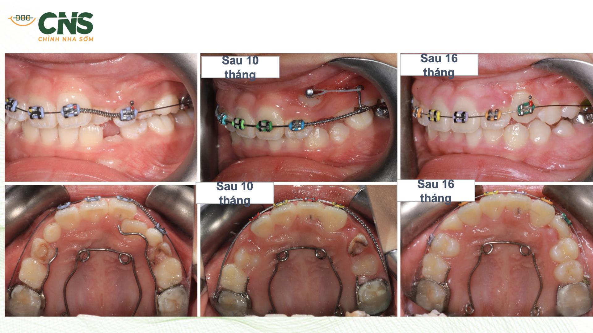 Chỉnh Nha Sớm Răng Lộn Xộn Và Răng Ngầm: Chỉ Định, Phân Loại Và Phác Đồ Theo Bằng Chứng