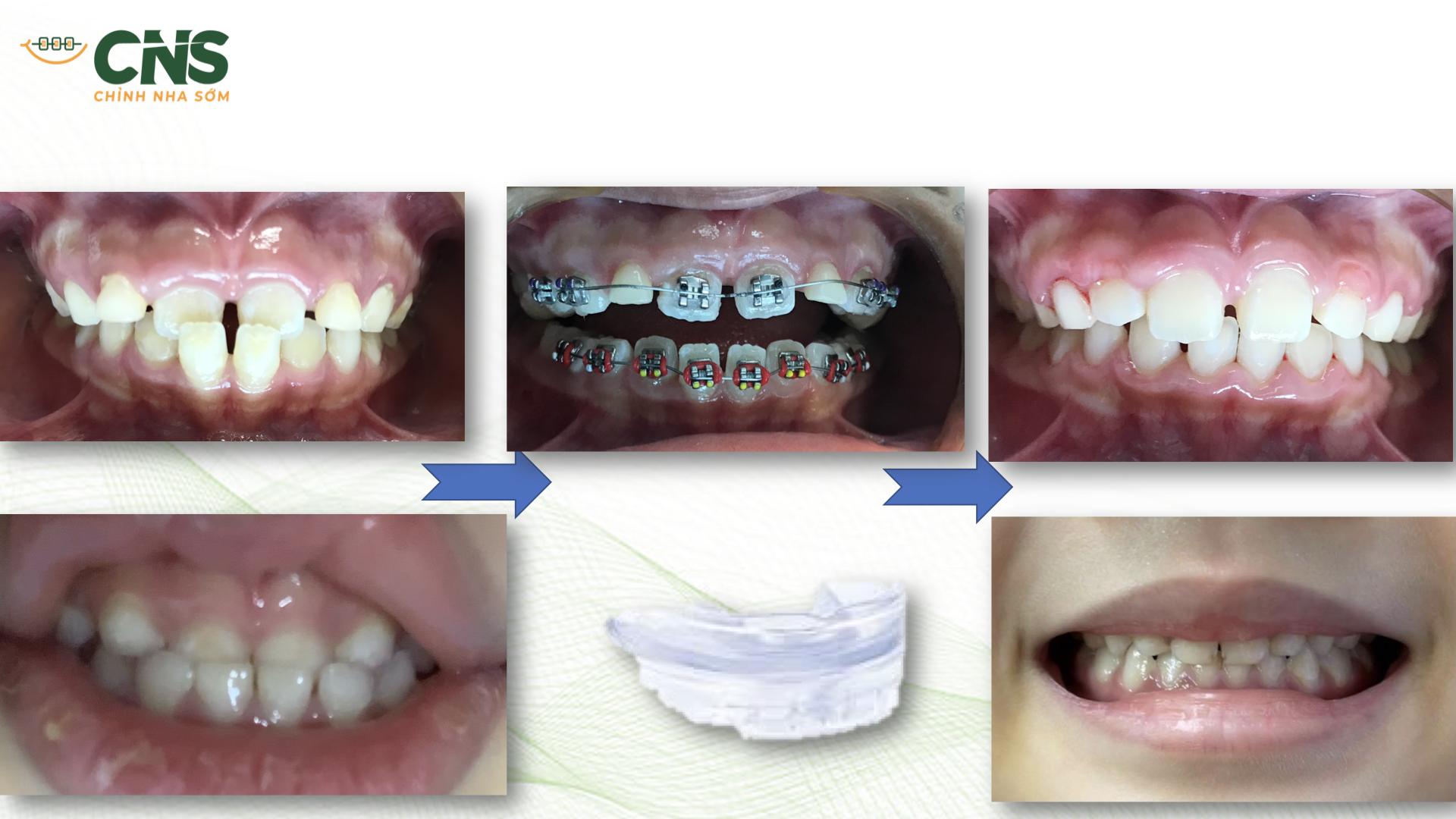 Cắn Ngược, Sai Khớp Cắn Hạng II Và Lệch Mặt: Chỉ Định Can Thiệp Sớm Theo Bằng Chứng