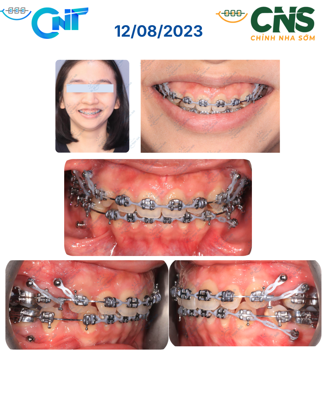 Báo Cáo Ca Lâm Sàng: Hạng II xương, cằm lùi kèm Cười Lộ Nướu: Lún Và Kéo Lui Nguyên Khối Hàm Trên Bằng Minivis