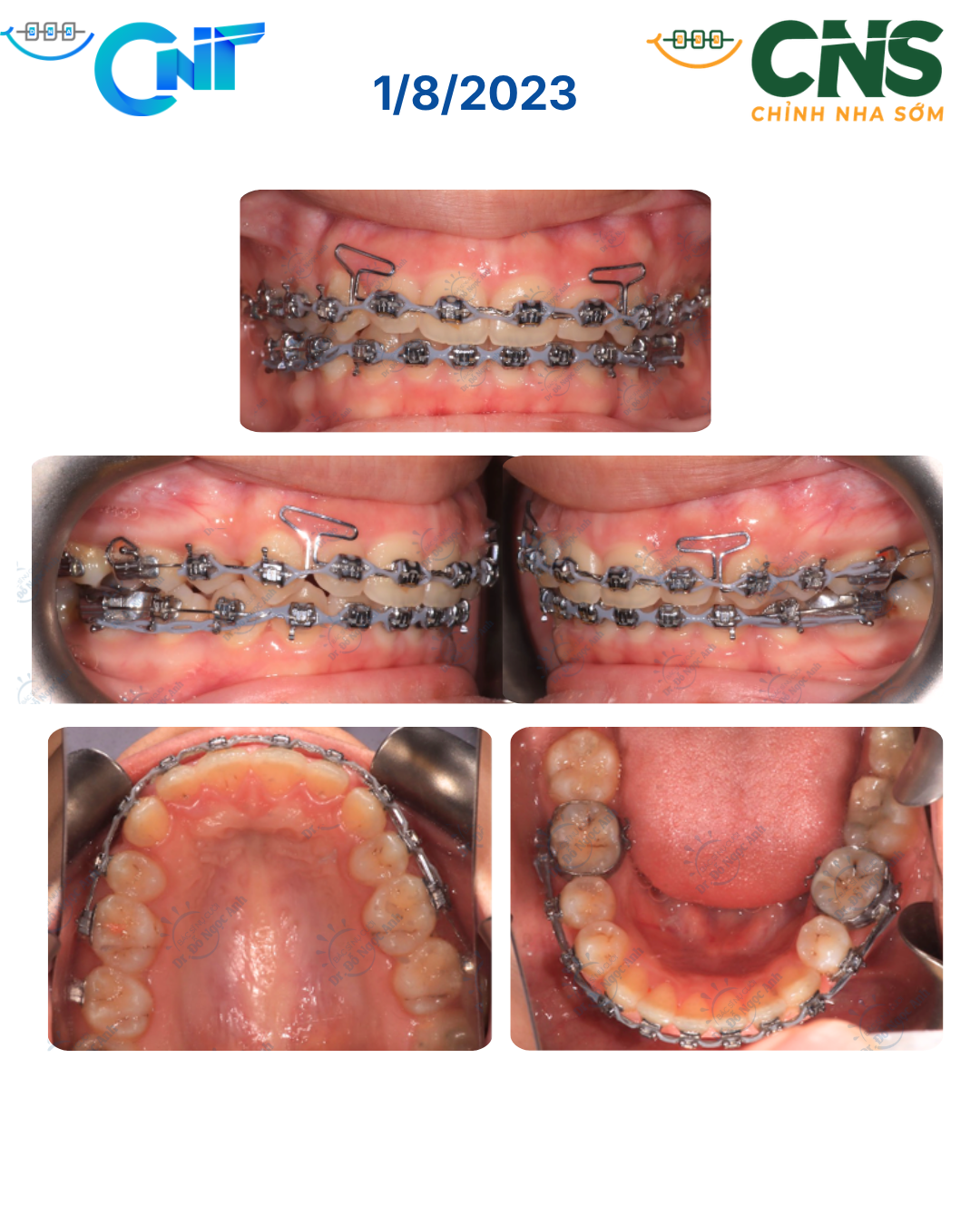 Báo cáo ca lâm sàng Điều trị nguỵ trang sai khớp cắn Hạng II xương nặng, lệch đường giữa và cằm lùi: nhổ răng bất cân xứng, đóng khoảng bằng loop và chỉnh nghiêng mặt phẳng cắn (canting) bằng minivis