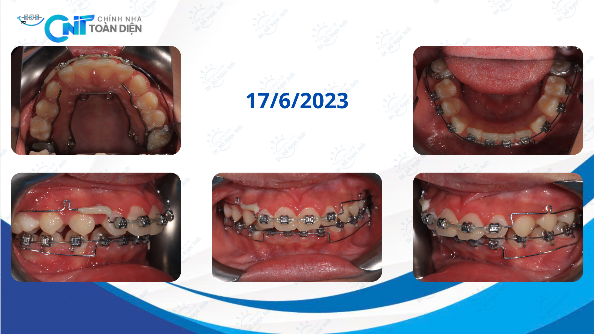 Báo cáo ca lâm sàng: Chỉnh nha 2 giai đoạn điều trị sai khớp cắn Hạng II xương ở bệnh nhân thở miệng